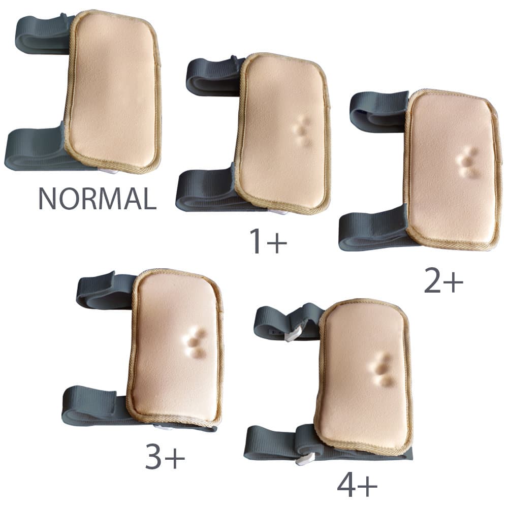 MW1 Pitting Edema Simulator